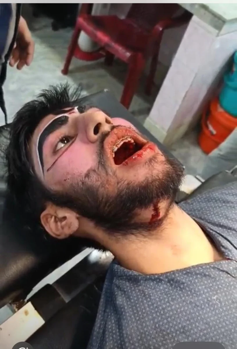 रामलीला मंचन के दौरान खर बने कलाकार की गर्दन में लगी तलवार, जीभ में भी आई चोट, अस्पताल में भर्ती अमित जोशी की हालत में सुधार